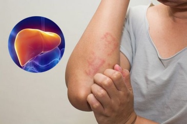 Men gan cao có nguy hiểm không? Cách điều trị hiệu quả
